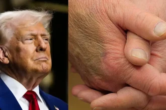 Trump's BRUISED HANDS Trigger Health Panic